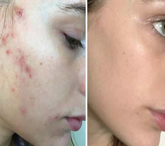 5 Reasons Your Acne Treatment Isn’t Working (And How to Fix It)