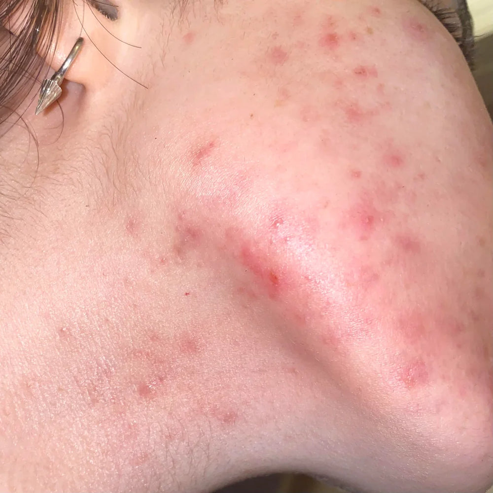 Woman with moderate acne, before using our ClearifySkin acne laser pen