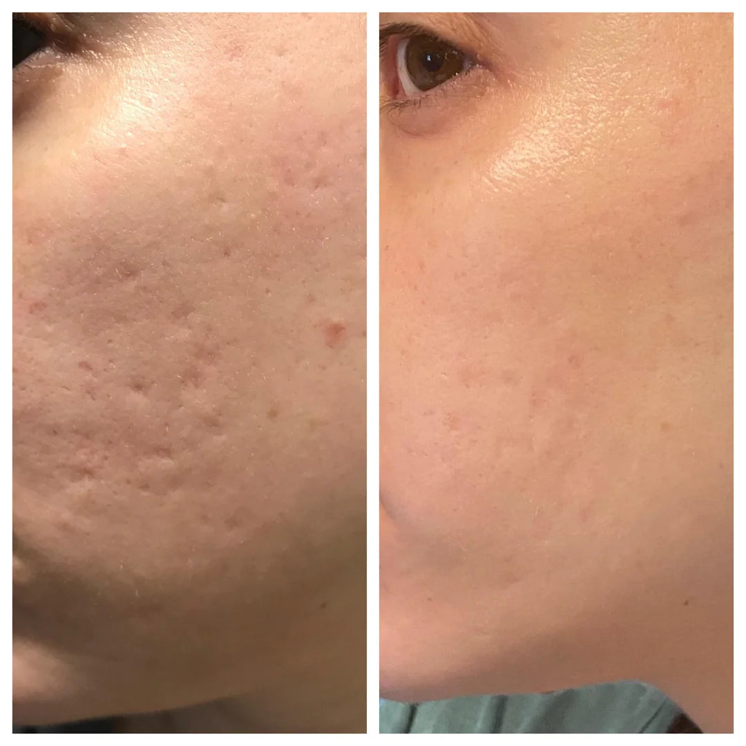 Blue LED acne treatment – visible before and after transformation with ClearifySkin
