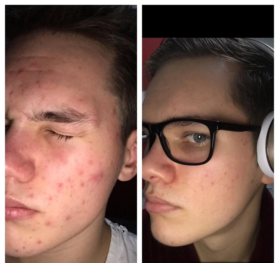 Male user showing acne improvement after ClearifySkin LED therapy