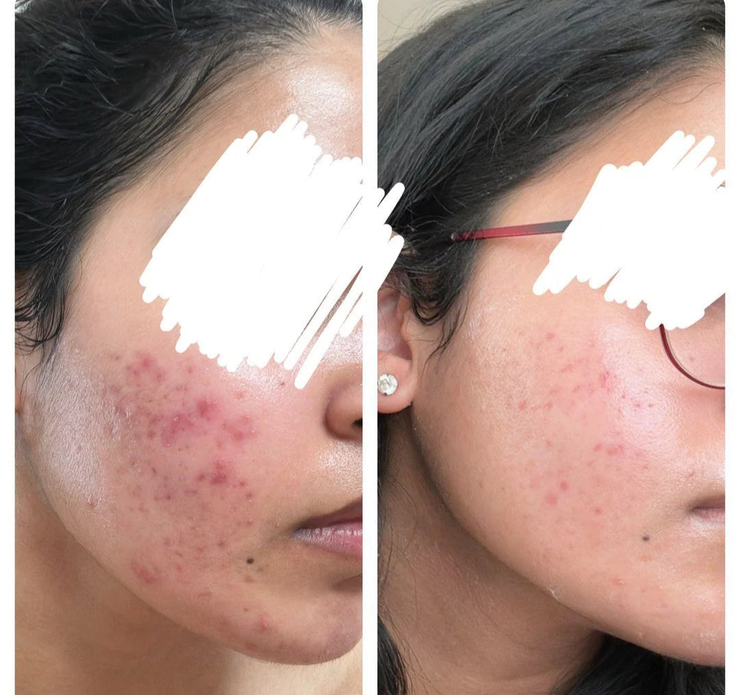 Visible skin improvement after blue light acne treatment – ClearifySkin results