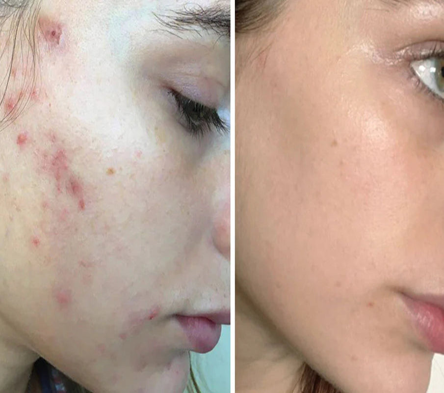 Before and after comparison of ClearifySkin acne treatment on young woman