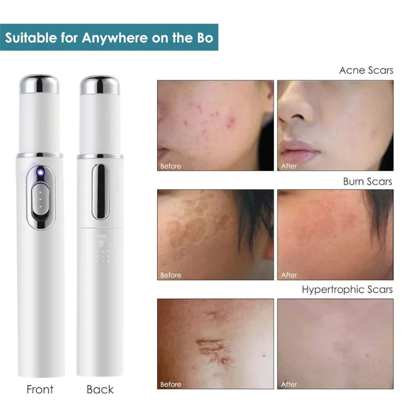 ClearifySkin Acne Laser Pen front and back views alongside before and after results for acne scars, burn scars, and hypertrophic scars - visible skin improvement with regular use