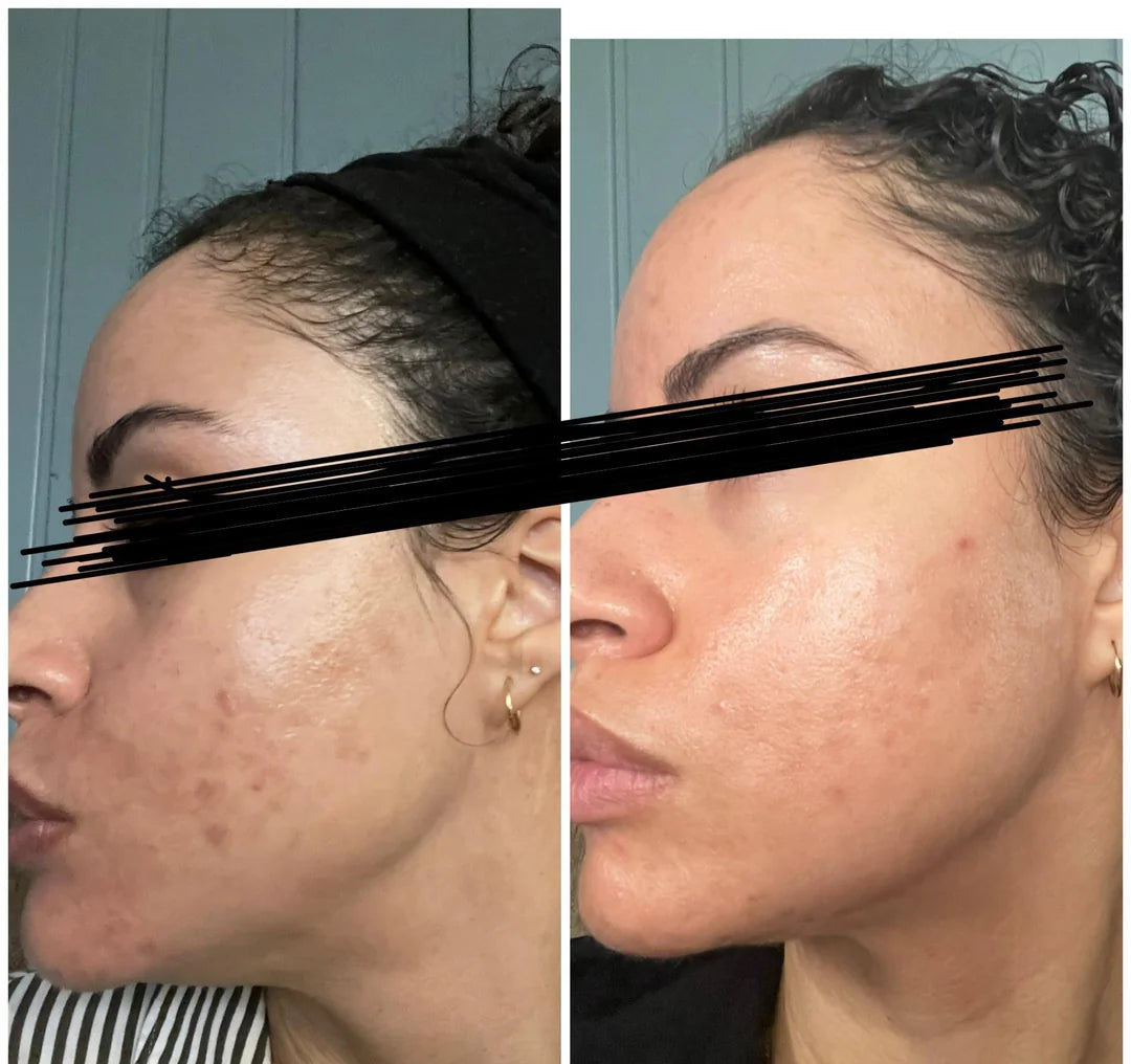 Female user before and after using ClearifySkin device – significant acne reduction