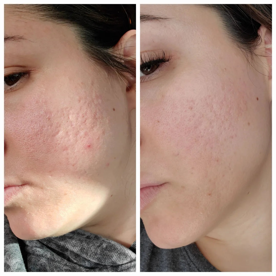 Acne cleared after consistent use of ClearifySkin device – before/after image