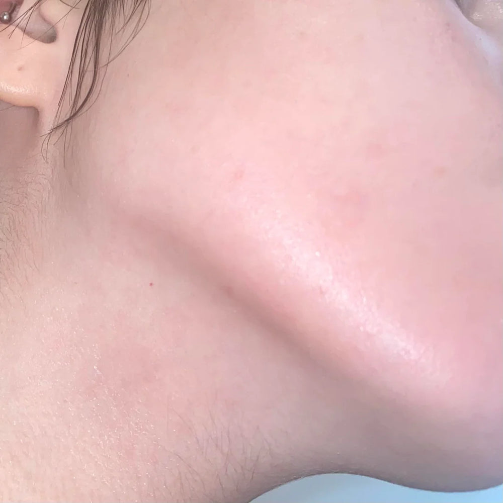 Woman transformation after using ClearifySkin acne laser pen, results